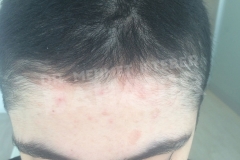 Before treatment